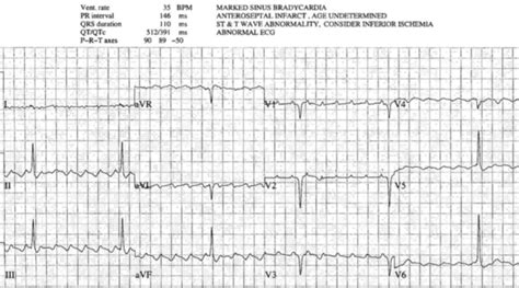 Beware Computer Interpretation Errors Ecg Cases Em Cases