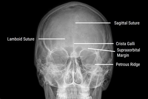 Sinus X Ray Positioning An X Ray Guide Medical Professionals
