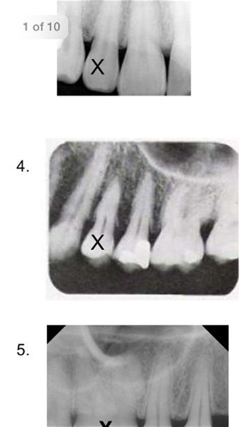 Print Dental Assisting X Ray Quiz 1 Flashcards Easy Notecards