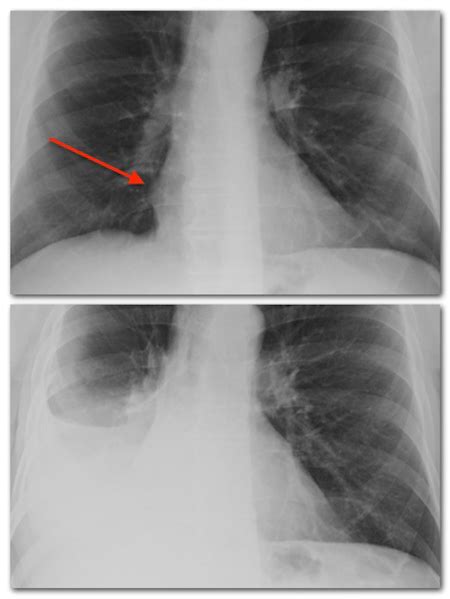 The Neighborhood Radiologist Language Of The Chest X Ray