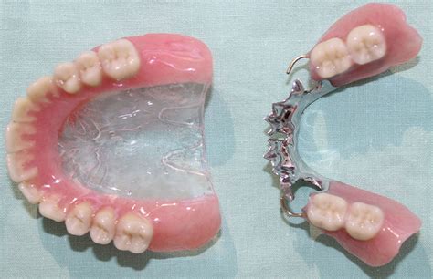Pictures Of Partial Dentures For Back Teeth Dentures Partial Plates