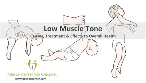 Low Muscle Tone In An Infant Or Child Is Not A Symptom To Ignore It