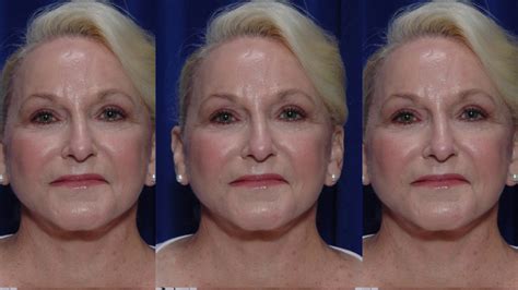 Facelift Results Combined With Fat Grafting And Forehead Reduction