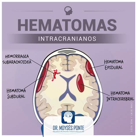 Hematomas Intracranianos Dr Moysés Ponte