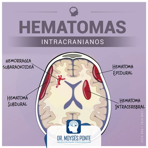 Craniotomia Para Drenagem De Hematoma Subdural