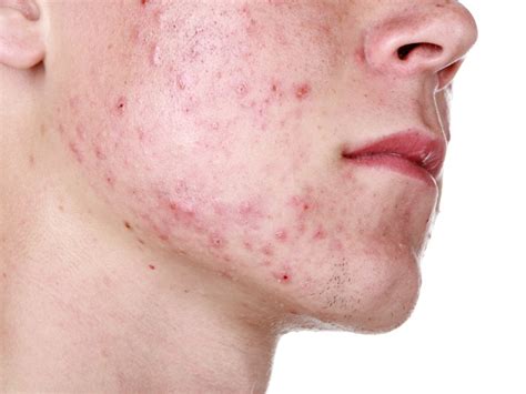 What Is Cystic Acne And Why Is It Caused Styles At Life