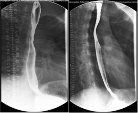 Pdf Diffuse Esophageal Narrowing In Eosinophilic Esophagitis A