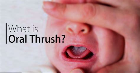 What Does Oral Thrush Look Like In The Mouth What Does