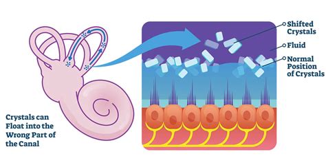Benign Positional Vertigo Ent Associates