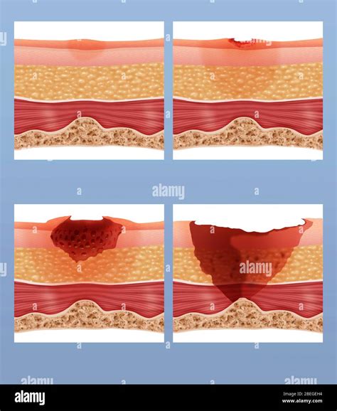 Bed Sores Hi Res Stock Photography And Images Alamy