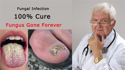 5 Way To Cure Fungal Infection On Skin Naturally Youtube