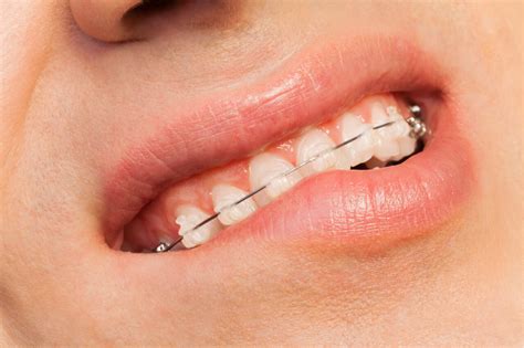 Do braces hurt? This is a question that crosses the mind of patients
