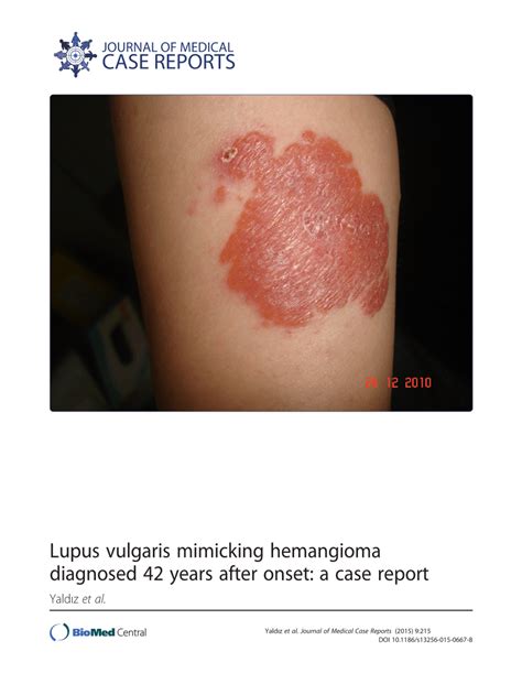 Pdf Lupus Vulgaris Mimicking Hemangioma Diagnosed 42 Years After
