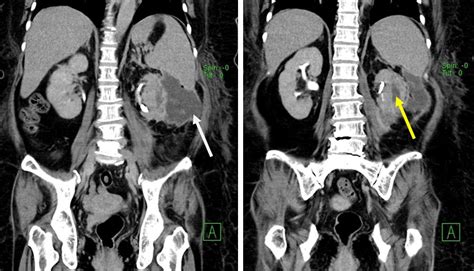 Renal Abscess With Perinephric Extension Radiology Cases