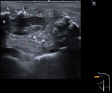 Ultrasound Of The Left Sternoclavicular Joint Showing A Fluid