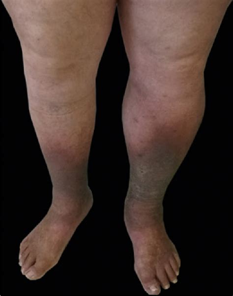 Figure 6 From Thick Legs Not Always Lipedema Semantic Scholar