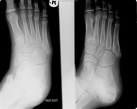 Xray Of Childs Foot