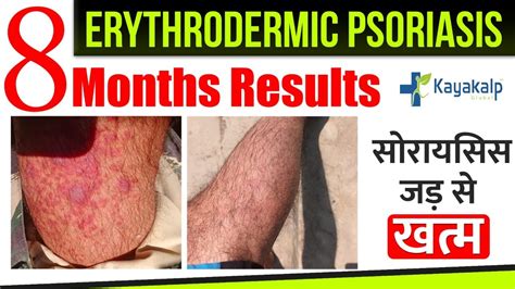 Erythrodermic Psoriasis Symptoms Causes And Treatment Is