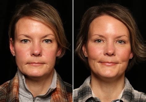 Blepharoplasty Photos Cincinnati Facial Plastic Surgery