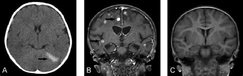 A Computed Tomography Indicated Left Tentorium Subdural Hemorrhage