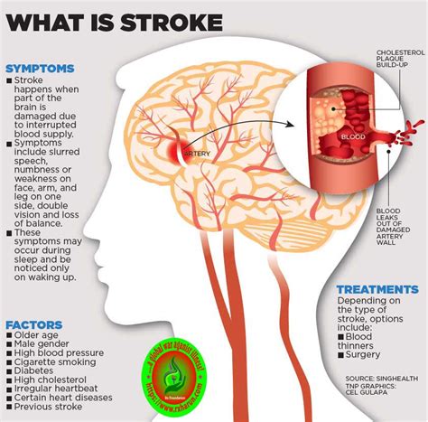 What Happens To Your Body When You Have A Strokeearly Sign Illnesshacker