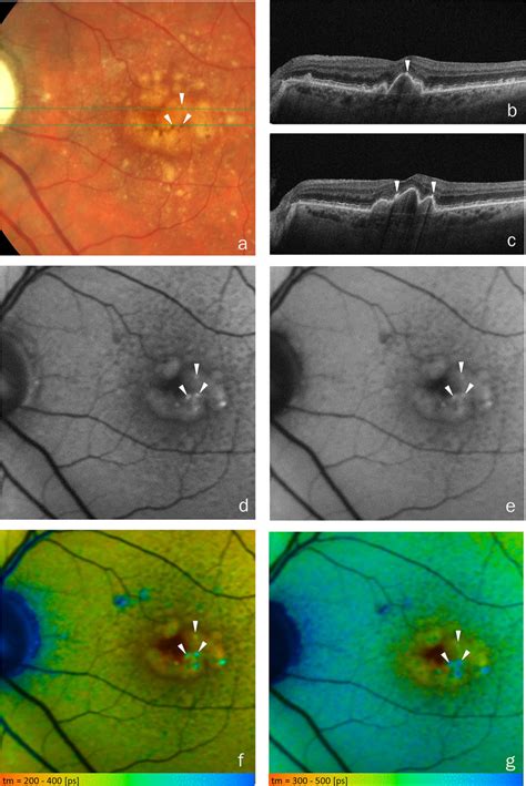 Rpe Cells Detaching From The Rpe Layer A Cfp B C Oct Scans Were