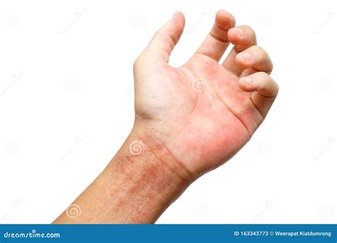 Itchy Rash On Wrists