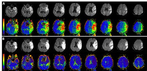 Neuroimaging Tools For Brain Edema Kimberly Lab