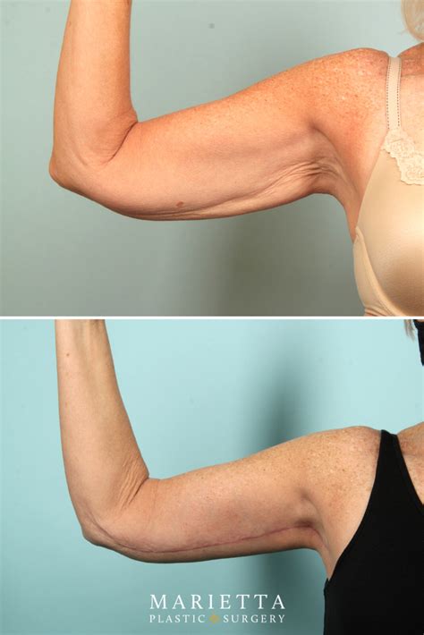 Arm Lift Before And After