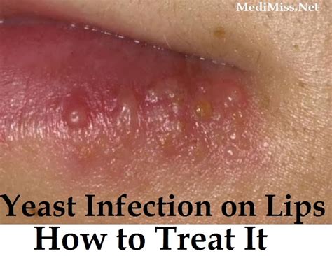 Yeast Infection On Lips How To Treat It Skinnyzine