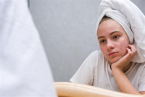 Premium Photo Acne A Sad Teenage Girl Problematic Skin In Adolescents