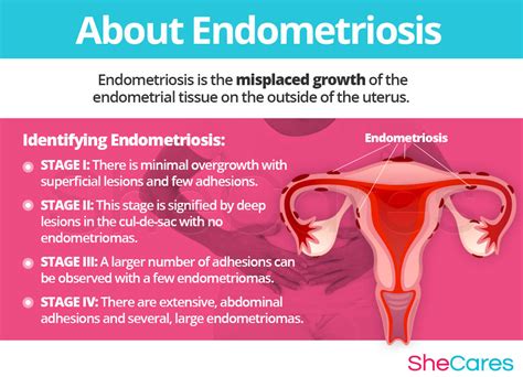endometriosis hormonal imbalance symptoms shecares