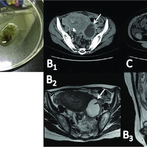 Stool And Ct Findings A A Sample Of Greenish Diarrhea B 1 3 Ct