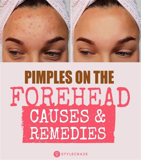 How To Get Rid Of Pimples On Forehead Pimples On Forehead Forehead