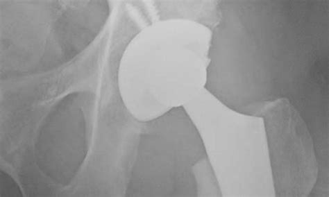 Superior Approach To The Hip In Total Hip Replacement Atx Orthopedics
