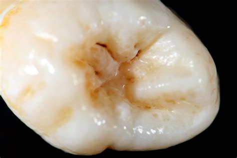 Mg8903 Wisdom Tooth Crown Details Flickr Photo Sharing