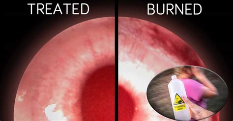 A Revolutionary Approach To Treating Chemical Burns In The Eye Using A