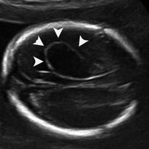 Absent Cavum Septum Pellucidi Teardrop Shaped Ventricles And An