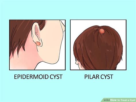 Doctor Approved Advice On How To Treat A Cyst Wikihow