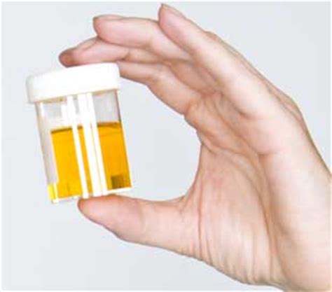 There are two types of blood in urine. Hematuria, Blood in the Urine | University of Iowa ...
