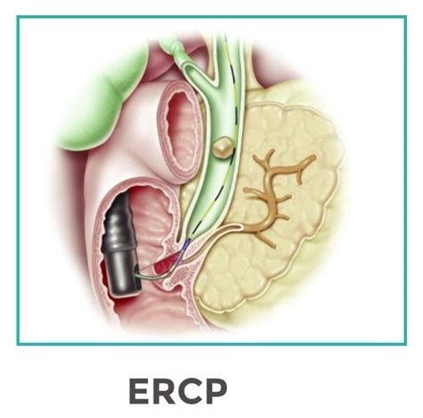 ERCP Endoscopic Retrograde Cholangio Pancreatography Dr Vatsal Mehta