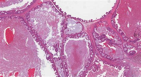 Salivary Duct Carcinoma Atlas Of Pathology