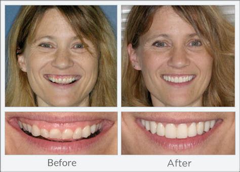 Get Reshaping Of Teeth Images Teeth Walls Collection For Everyone