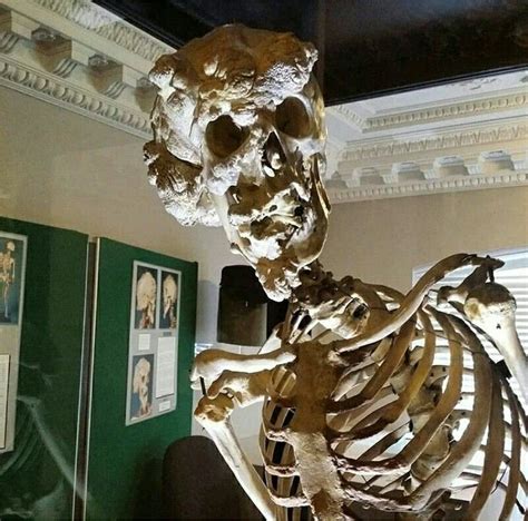 The Real Skeleton Of Joseph Merrick Aka The Elephant Man Photo By