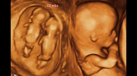 Fetal Anomaly Scan London Spectra