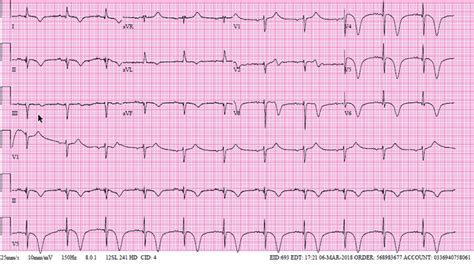 Ecg With Deep T Wave Inversions In Precordial Leads Presenting As