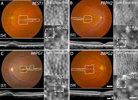 Una Nueva Técnica De Imagen Revela Detalles Imperceptibles Sobre La Distrofia Macular