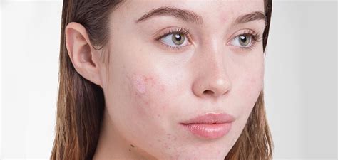 How To Get Rid Of Cystic Acne