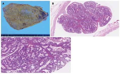 Rare Combination Of Familial Adenomatous Polyposis And Gallbladder Polyps