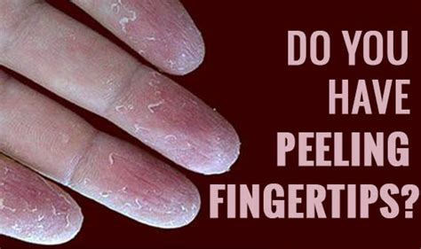 Do You Have Peeling Fingertips The Wellness Corner